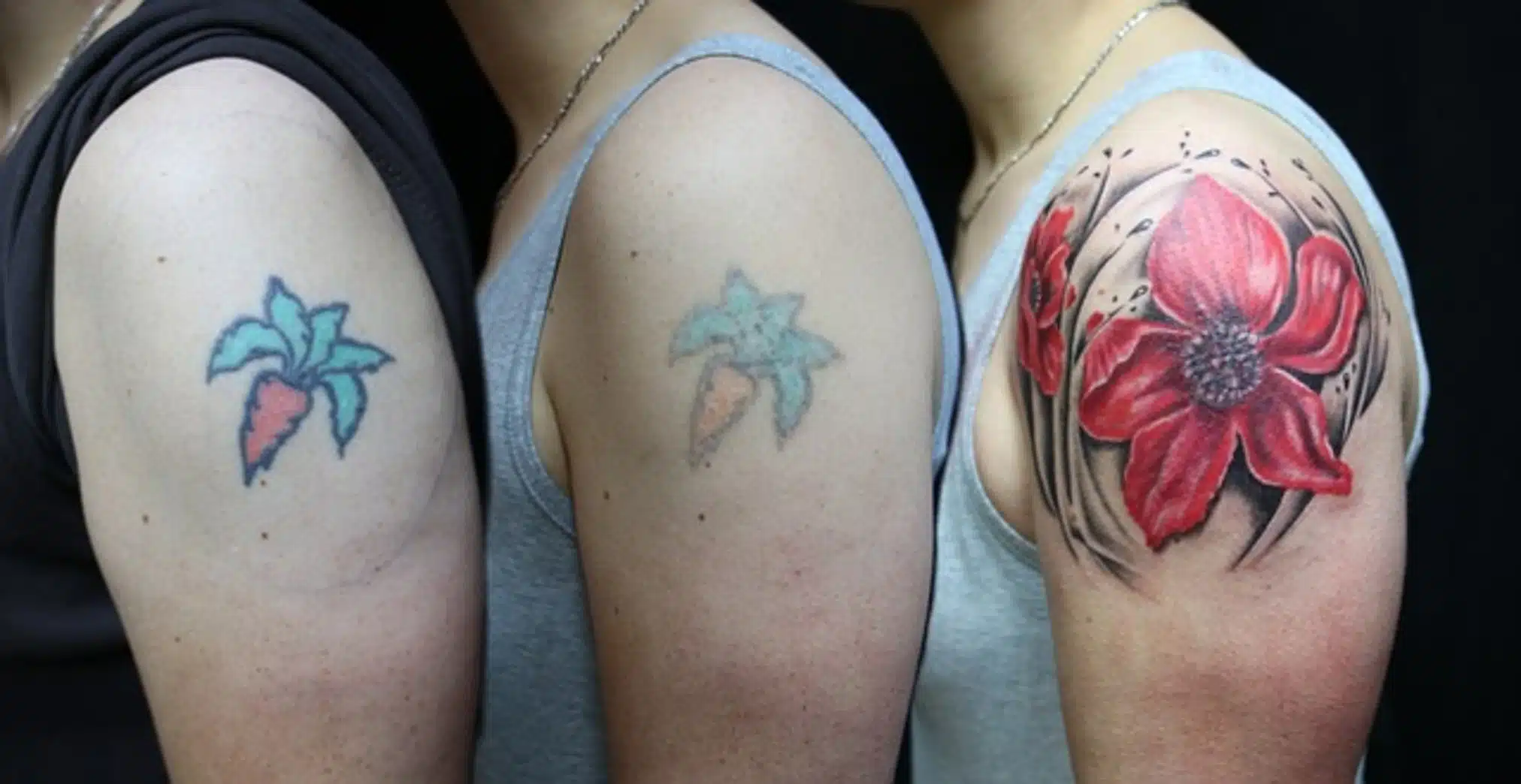 How to Safely Remove Your Tattoo