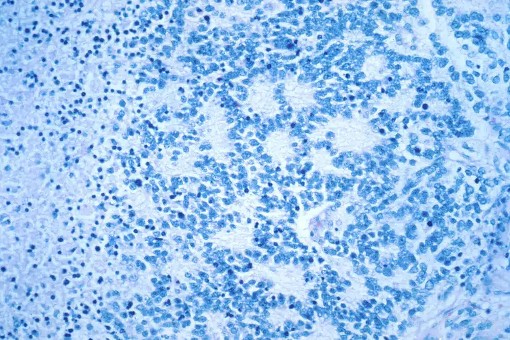 Novel Treatment Shows Promise Against Rare Cancer In Kids cancer