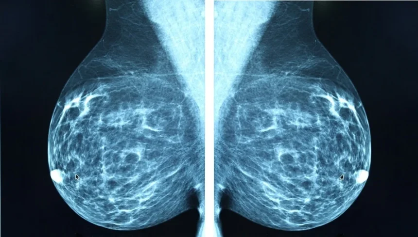Breast Cancer Detection