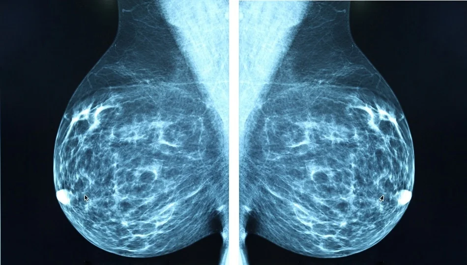 Breast Cancer Detection