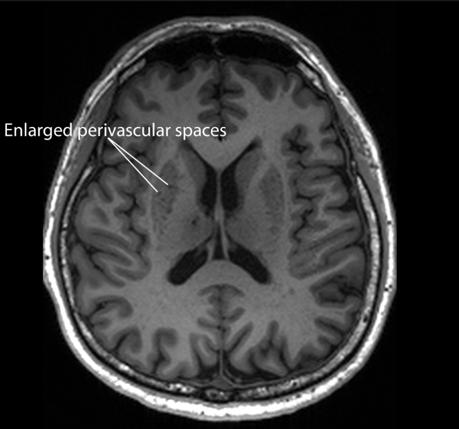 Clogged ‘drains’ in the brain Alzheimer’s
