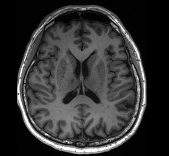 Clogged ‘drains’ in the brain Alzheimer’s